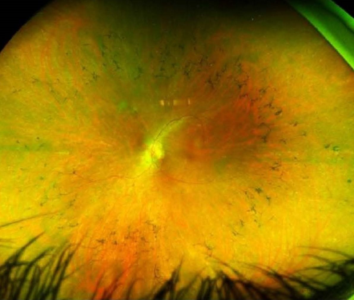 Breakthrough for genetic eye disease